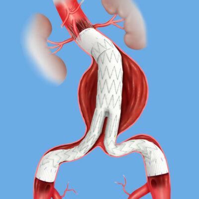 Aortic Intervention – Obex